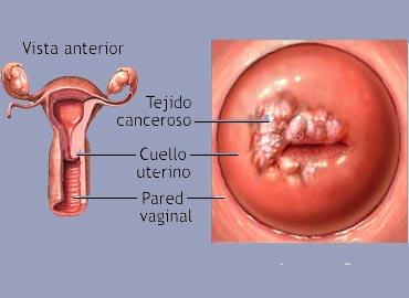 foto papiloma